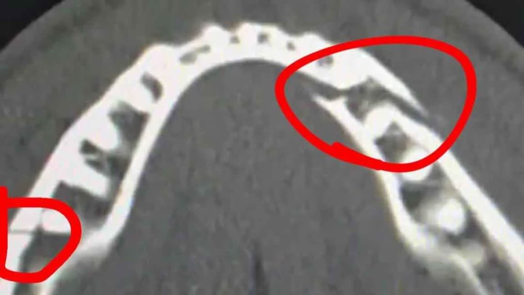 صورة فك بول