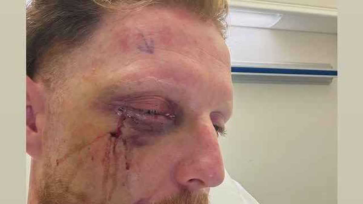 بن ستوكس مصاب