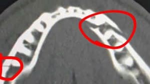 صورة فك بول