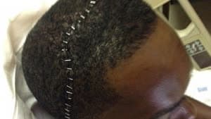 بالصور.. تدبيس رأس لاعب بيسبول بعد إصابته بكسور خطيرة