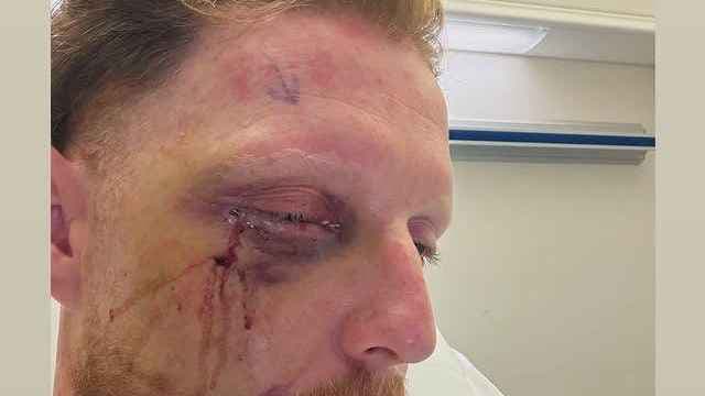 بن ستوكس مصاب